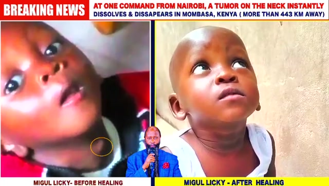 Migul Licky- Tumor on neck- mombasa